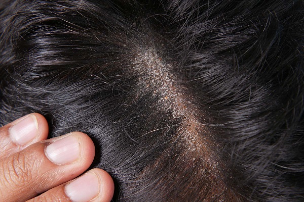 Remedies for Dry Hair | ಒಣ ಕೂದಲಿನ​ ತೊಂದರೆಯೇ? ಇಲ್ಲಿವೆ 5 ಸರಳ ಮನೆಮದ್ದುಗಳ ಐಡಿಯಾ!