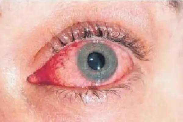 Madras eye affected eye.