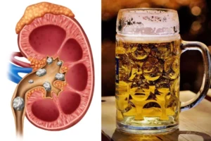 Beer good for Kidney Stone